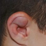 سرطان لاله گوش چیست و چه علائمی دارد؟