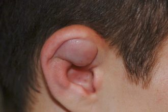 سرطان لاله گوش چیست و چه علائمی دارد؟