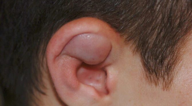 سرطان لاله گوش چیست و چه علائمی دارد؟