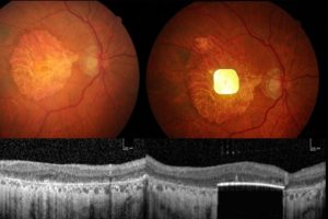 ایمپلنتی که بینایی را بازمی‌گرداند