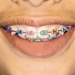 چگونه با ارتودنسی مسواک بزنیم؟