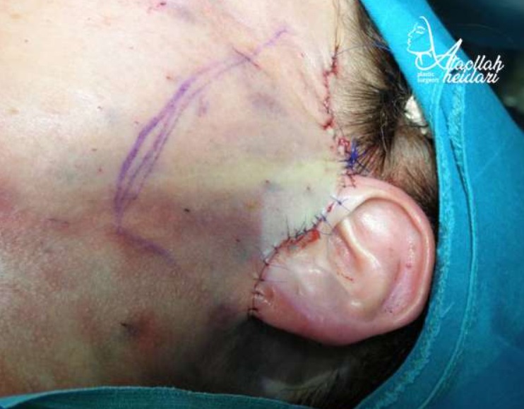 ورم بعد از جراحی لیفت صورت