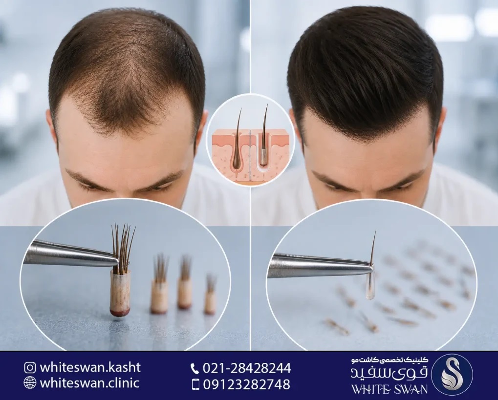 خدمات کاشت مو